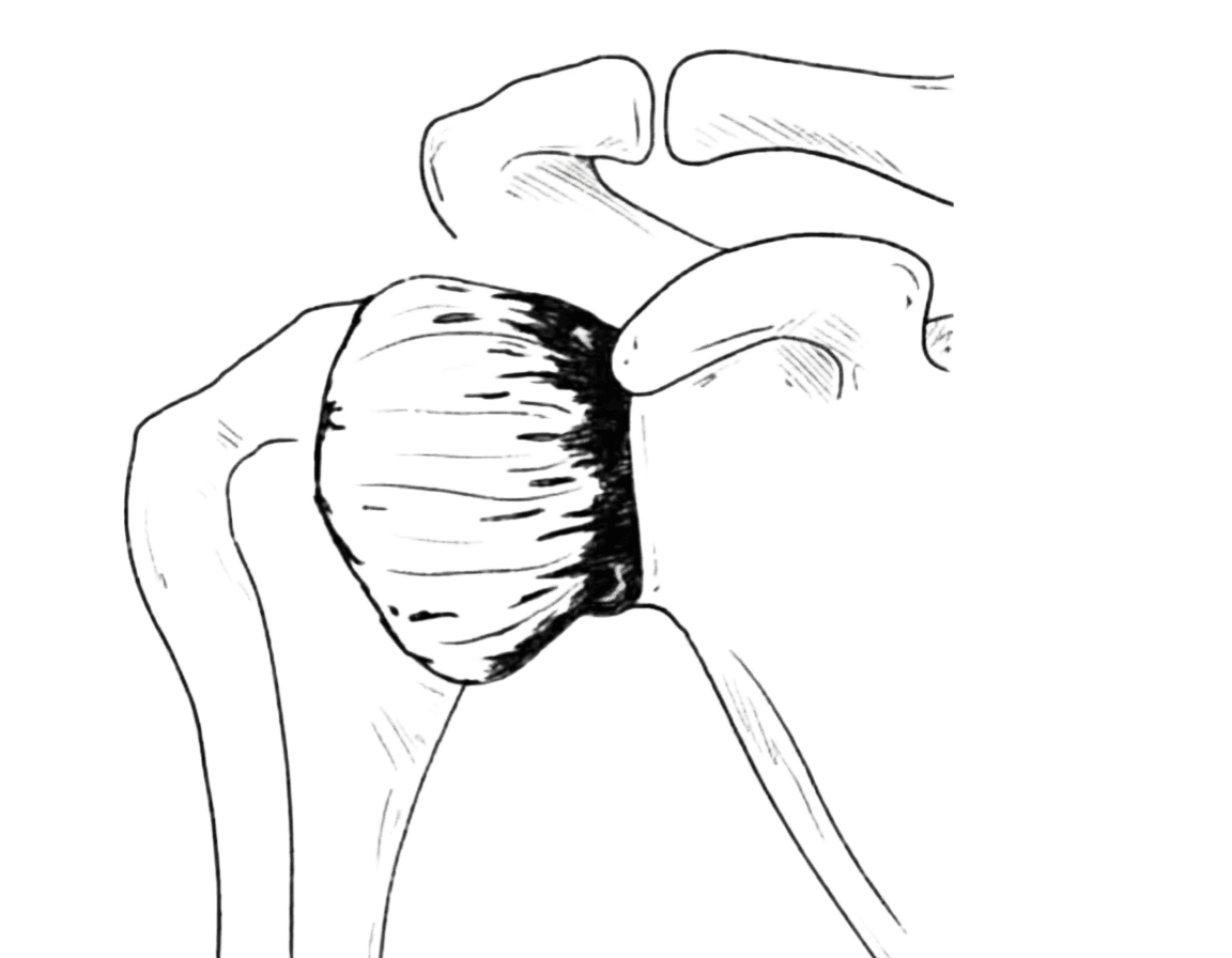 Capsulite rétractile