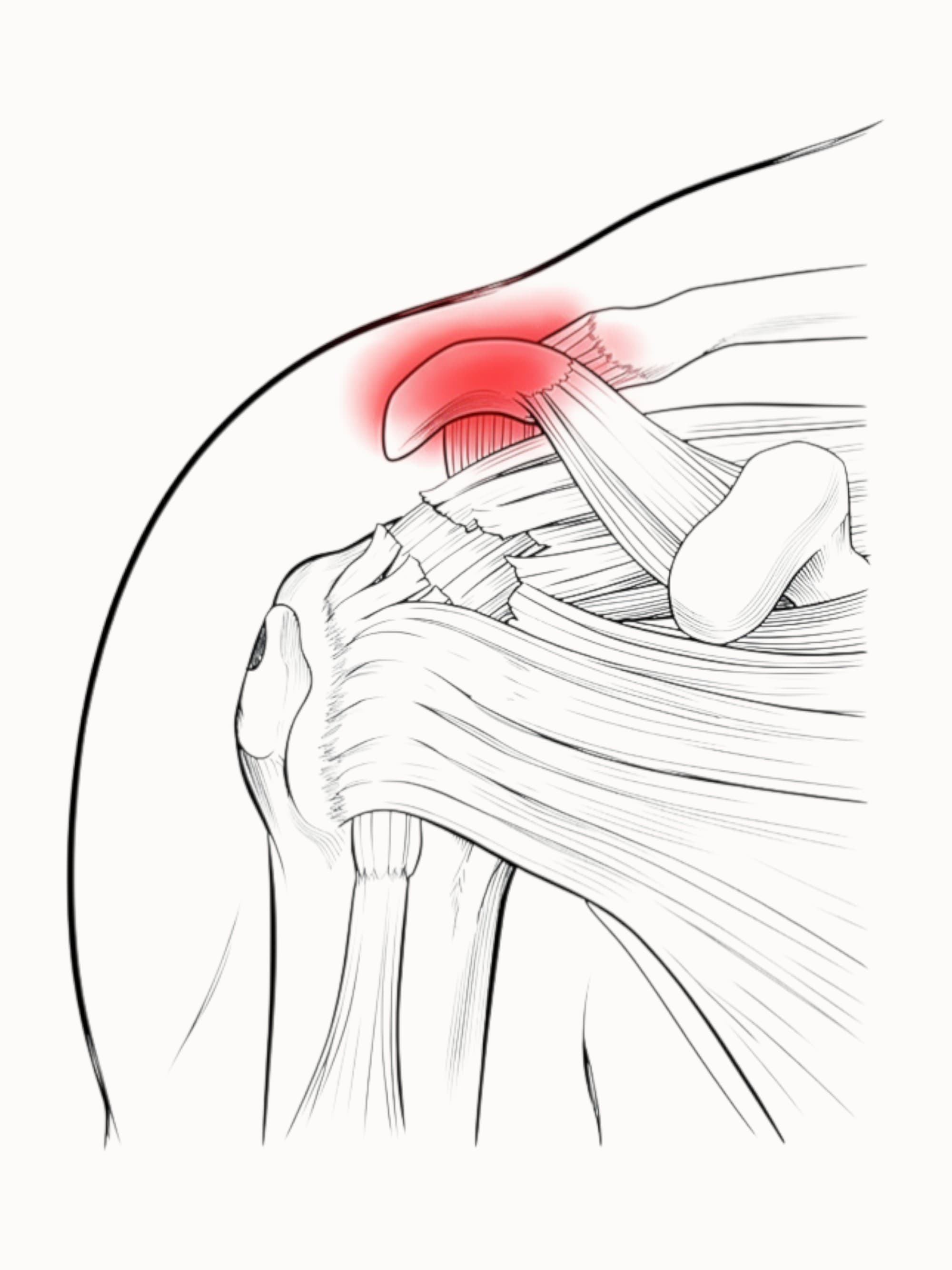 Rupture de la coiffe des rotateurs